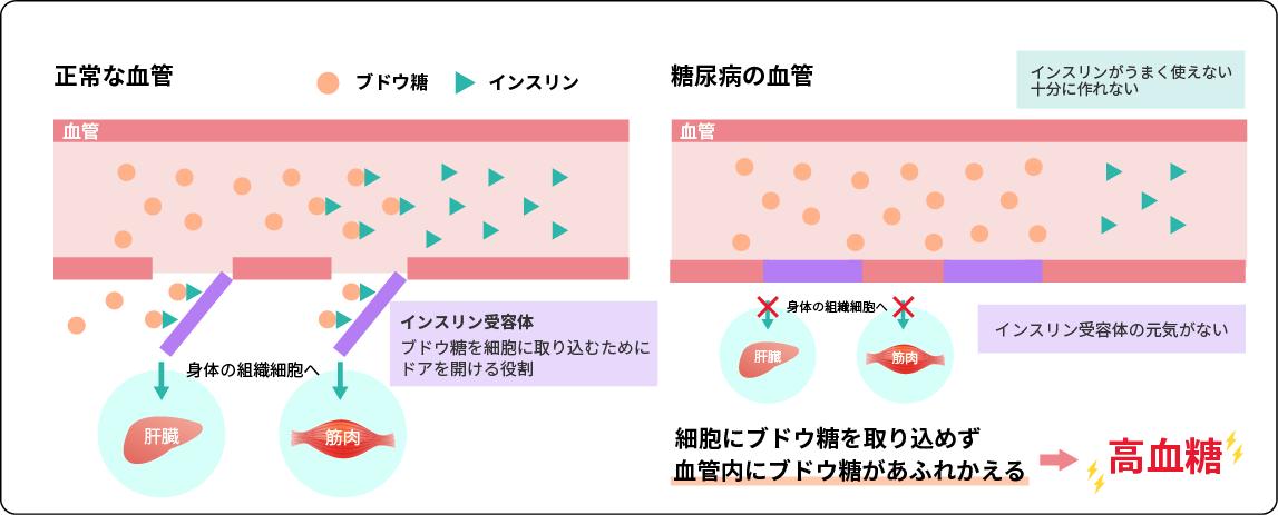 正常な血管　糖尿病の血管